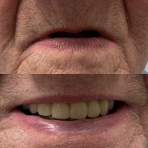 Complete Dentures - Before and After