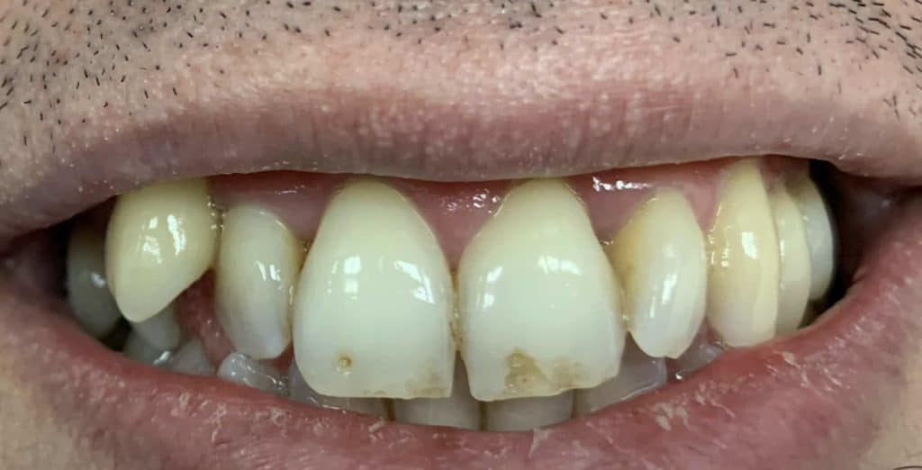 Simple Cosmetic Dental Care - Before