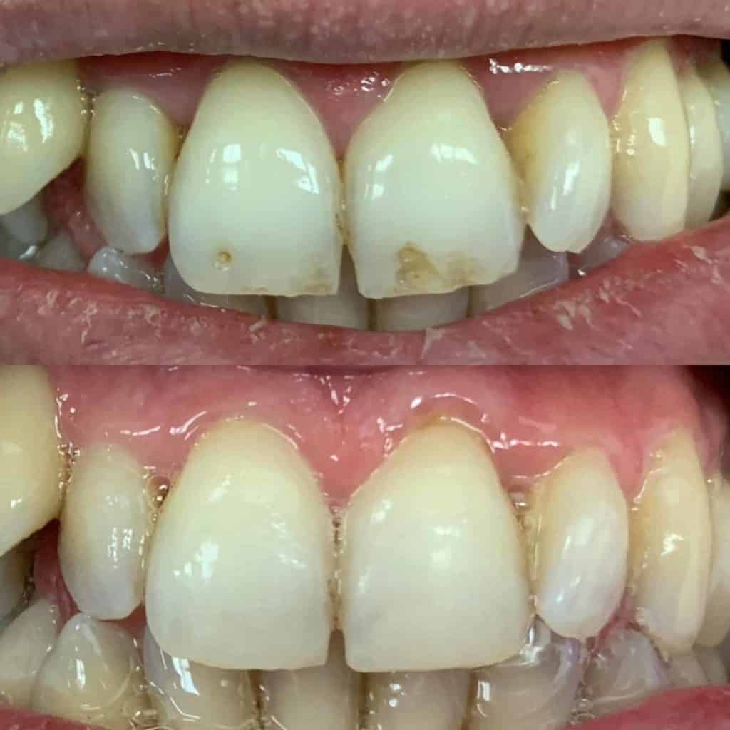 Simple Cosmetic Dental Care - Before and After