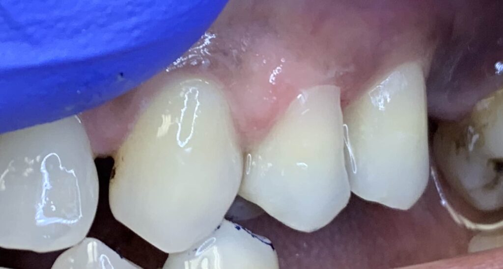 Dental Filling / Dental Bonding / White Filling - After