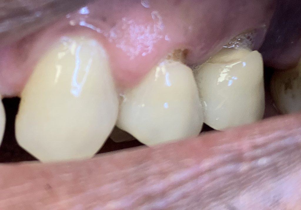 Dental Filling / Dental Bonding / White Filling - Before