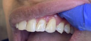 Front Tooth Filling - After