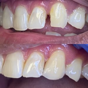 Front Tooth Filling. Beautiful Smile