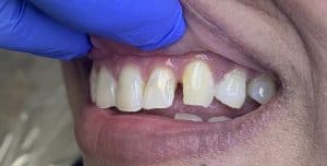 Front Tooth Filling - Before