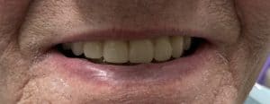 Complete Dentures - After