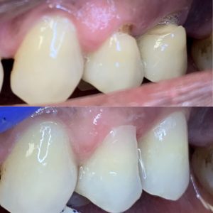 Dental Filling / Dental Bonding / White Filling - Before and After