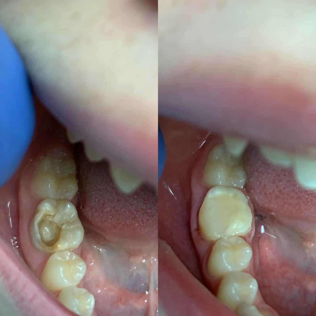 Root Canal Treatment And Filling - Before and After