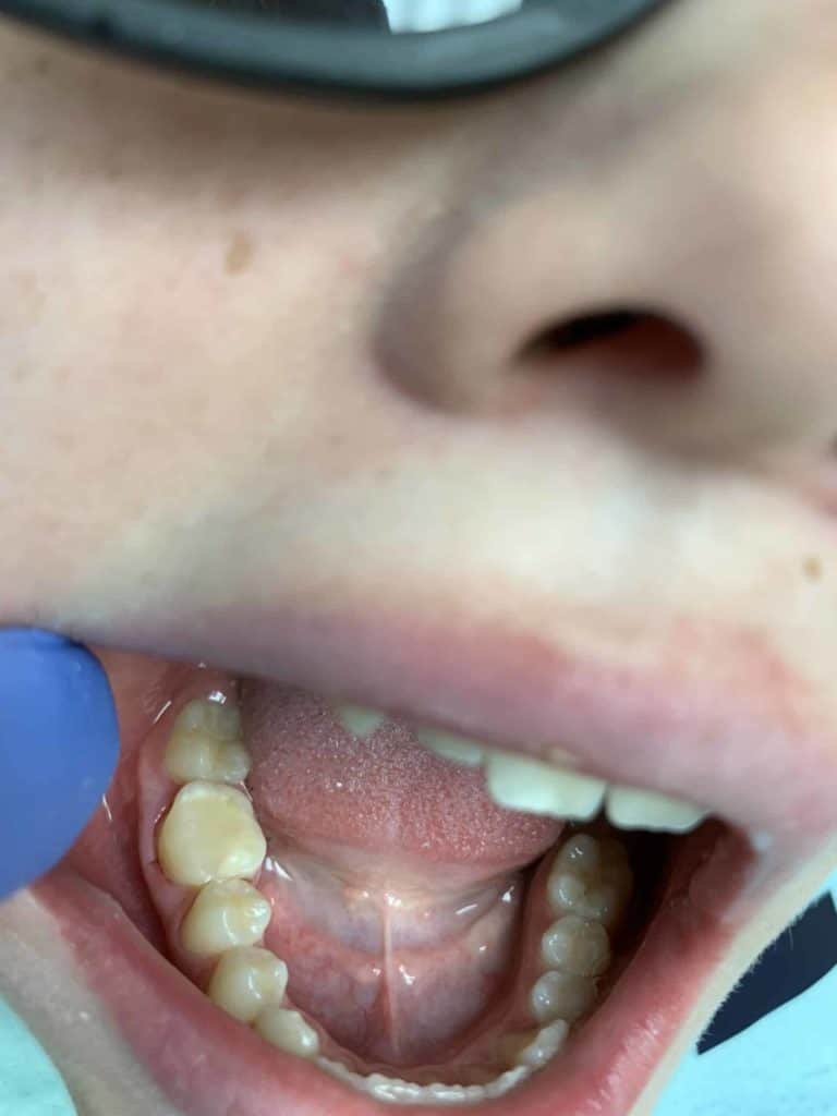 Root Canal Treatment And Filling - After