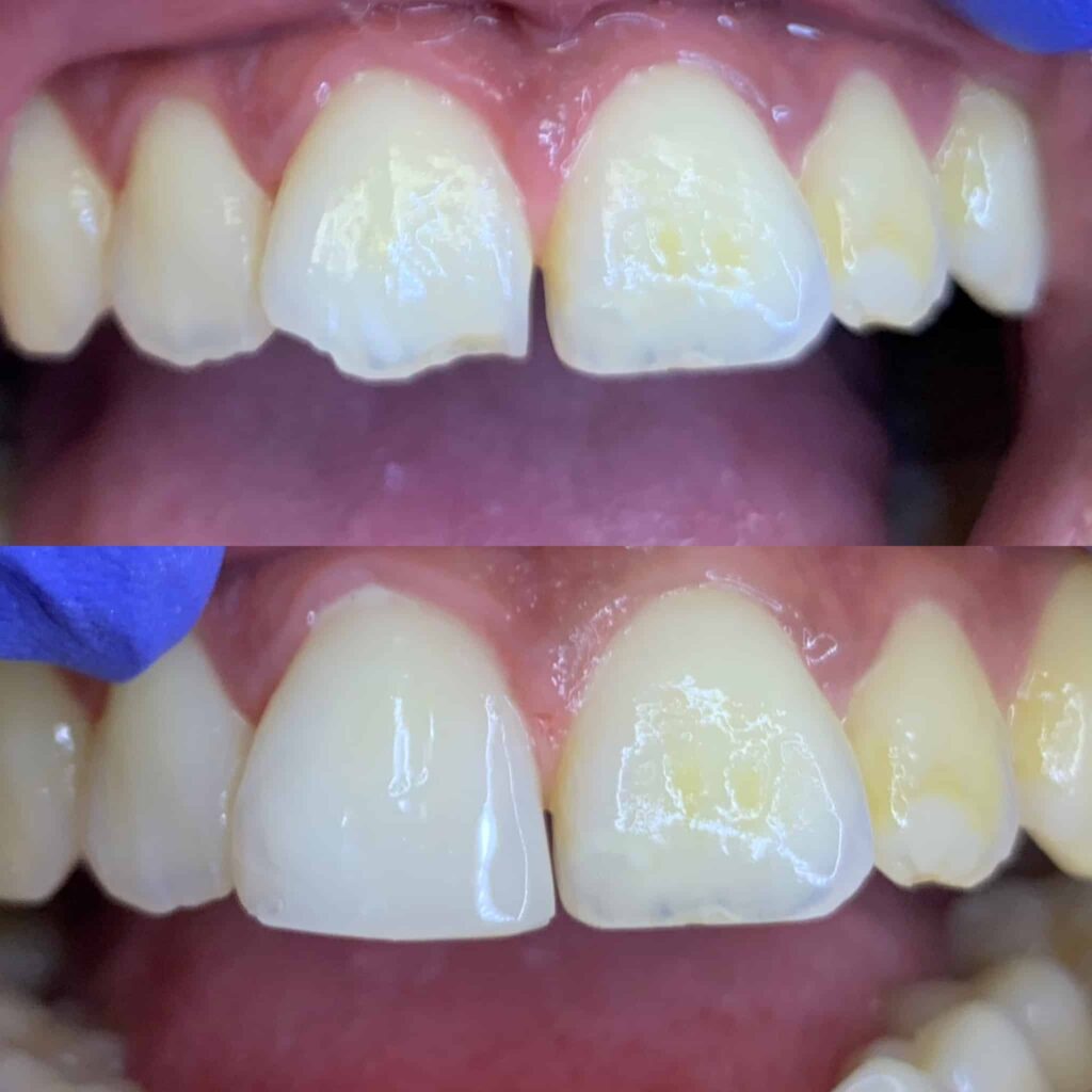 Easy and affordable front tooth filling
