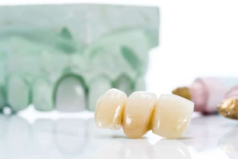 dental bridge